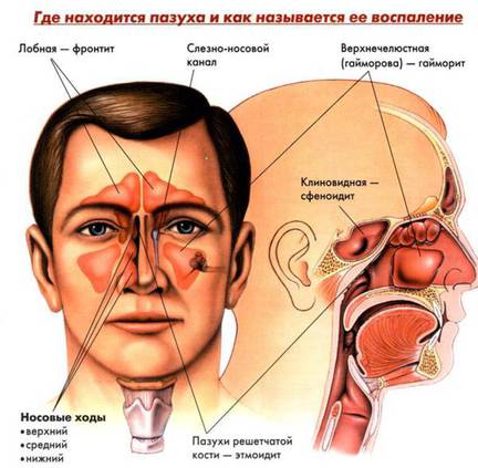 Проявления синуситов (воспаление придаточных пазух носа).jpg